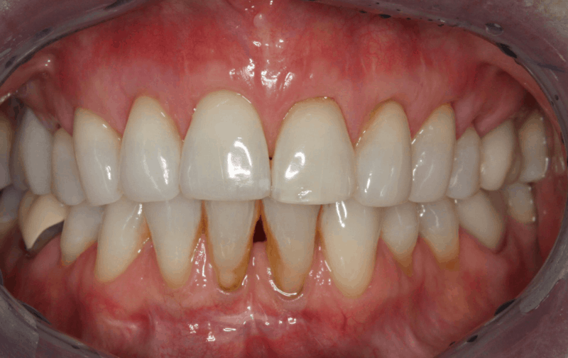 soft-tissue-gum-grafting-after